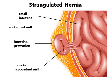 Tips To Prevent Hernia While Working Out – Icici Lombard