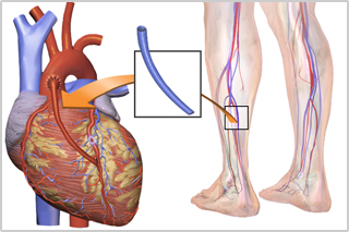 CABG_surgery_is_a_way_to_treat_patients_with_CHD